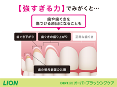 DENT.EX オーバーブラッシングケア_イメージ3