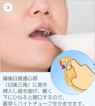 3. 最後臼歯遠心部（臼後三角）に指を挿入し指を曲げ、軽く下にひねると開口するので、素早くバイトチューブをかませます。
